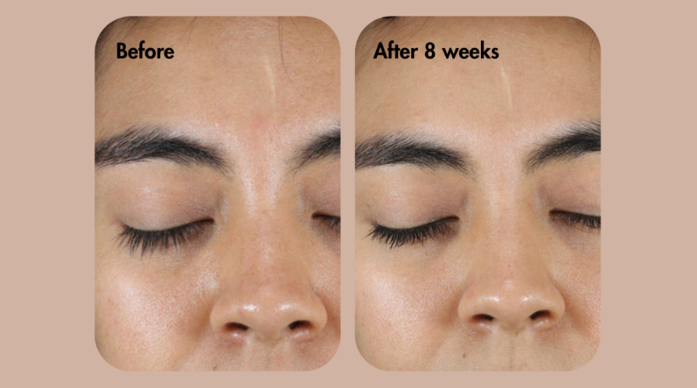 Comparación del antes y el después del tratamiento de cejas en el rostro de una persona.